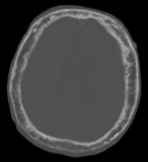 Maladie osseuse de Paget — Wikipédia