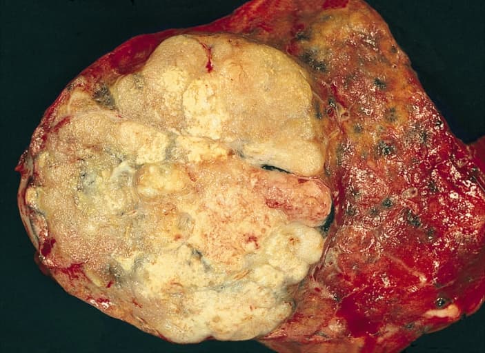 Adenocarcinoma of the lung - Wikipedia