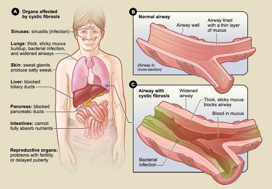 Cystic fibrosis - Wikipedia
