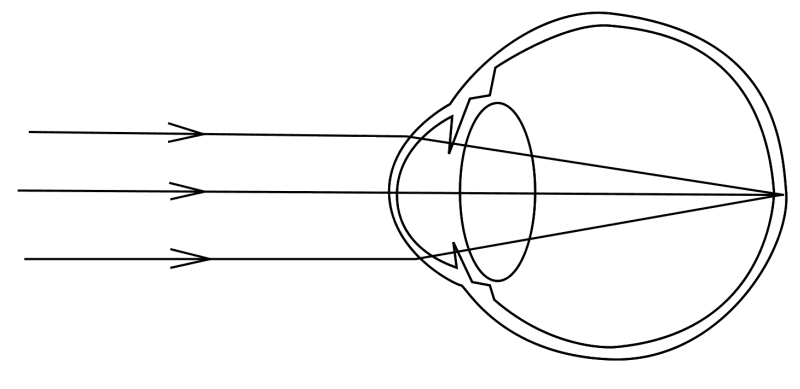 Emmetropia - Wikipedia