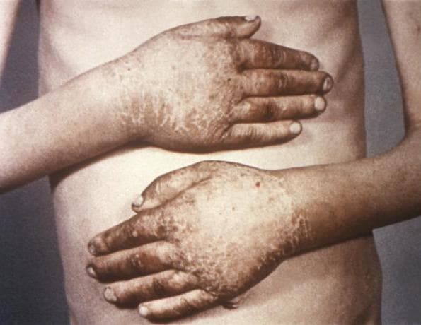 Micronutrient deficiency - Wikipedia