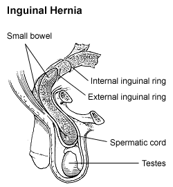 Hernia - Wikipedia