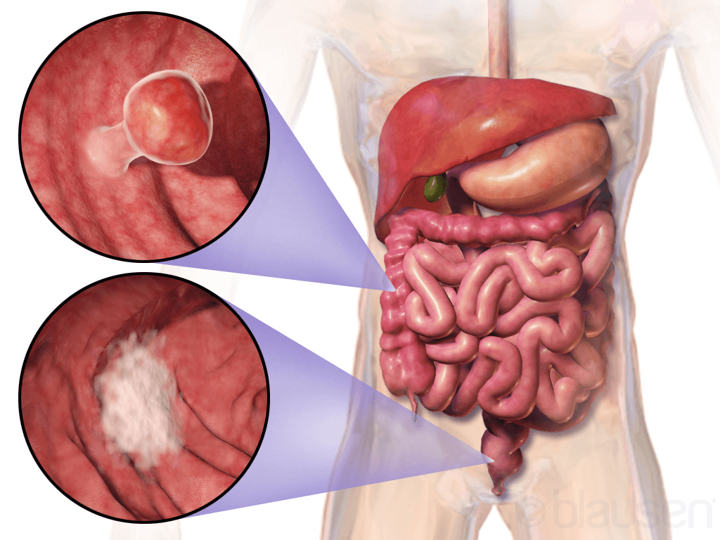 Colorectal cancer - Wikipedia