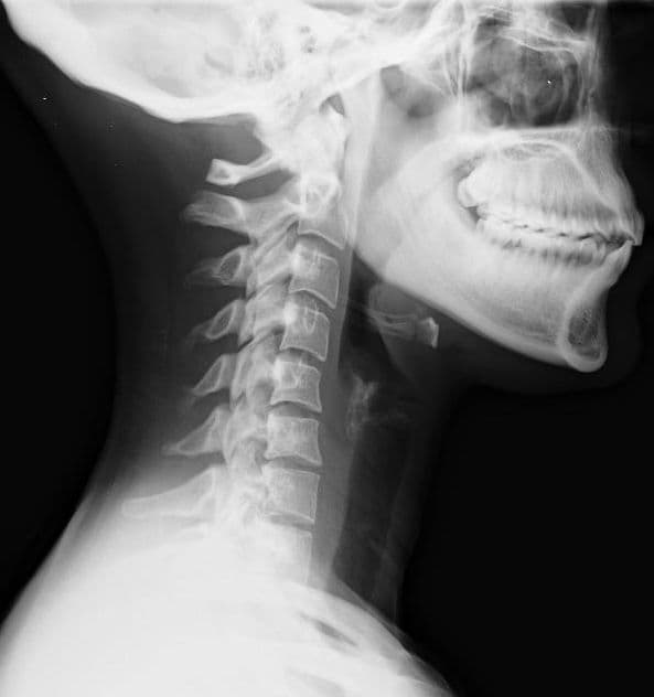 Whiplash (medicine) - Wikipedia