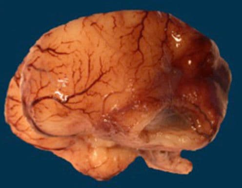 Microlissencephaly - Wikipedia