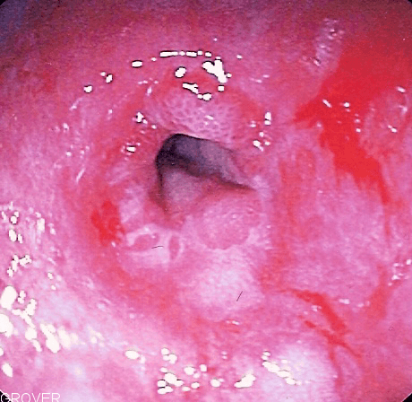 Esophageal stricture - Wikipedia