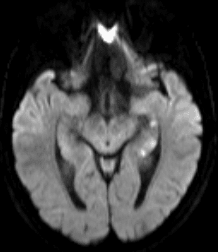 Transient global amnesia - Wikipedia