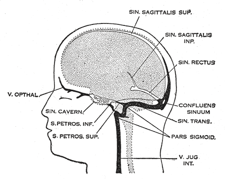 Cerebral venous sinus thrombosis - Wikipedia