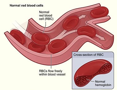 Hemolytic anemia - Wikipedia