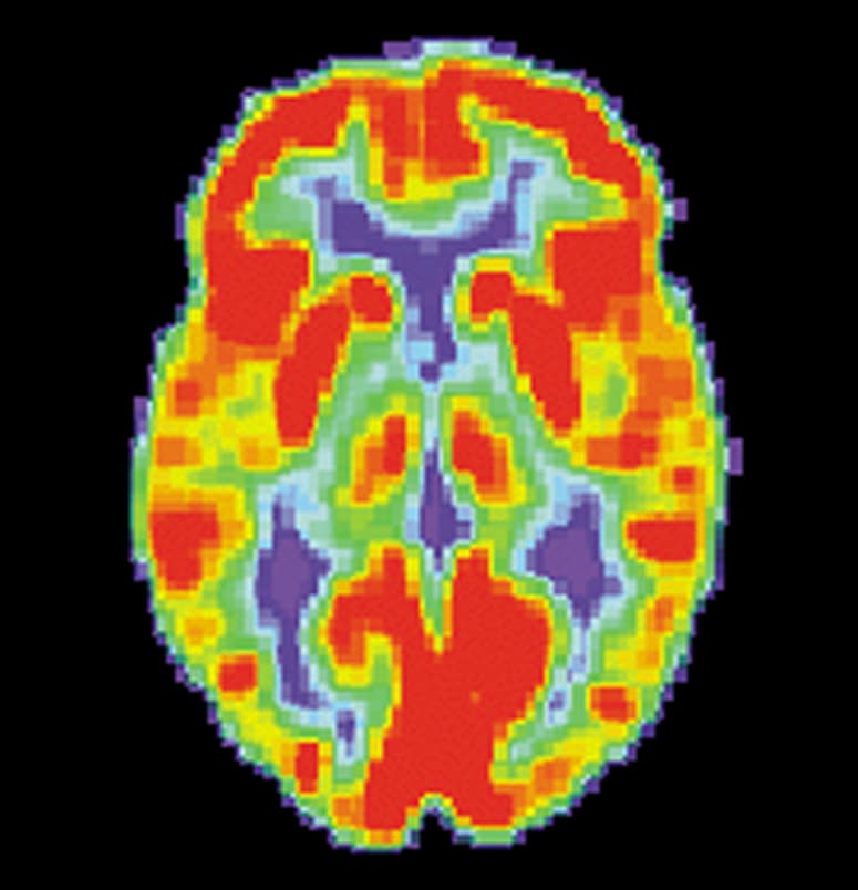Brain positron emission tomography - Wikipedia