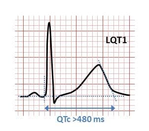 Long QT syndrome - Wikipedia