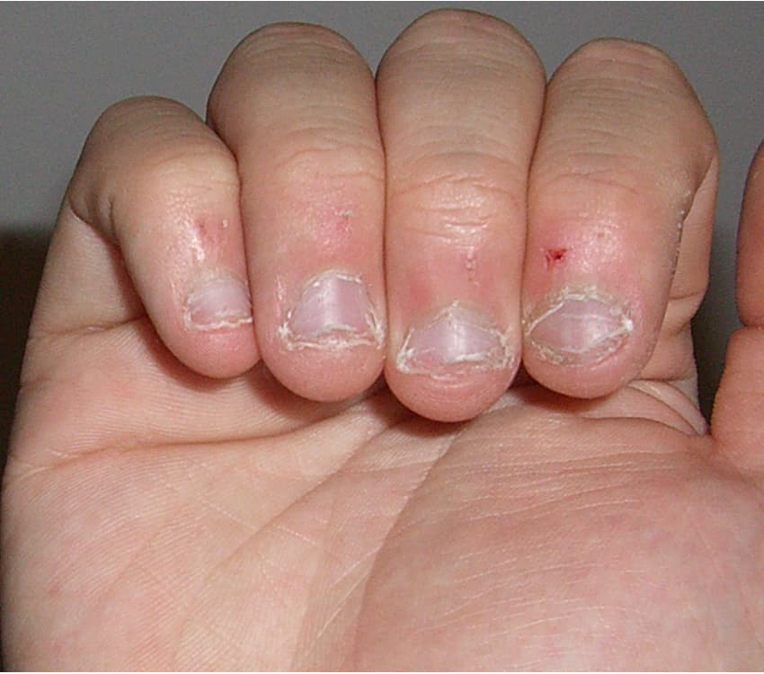 Nail biting - Wikipedia