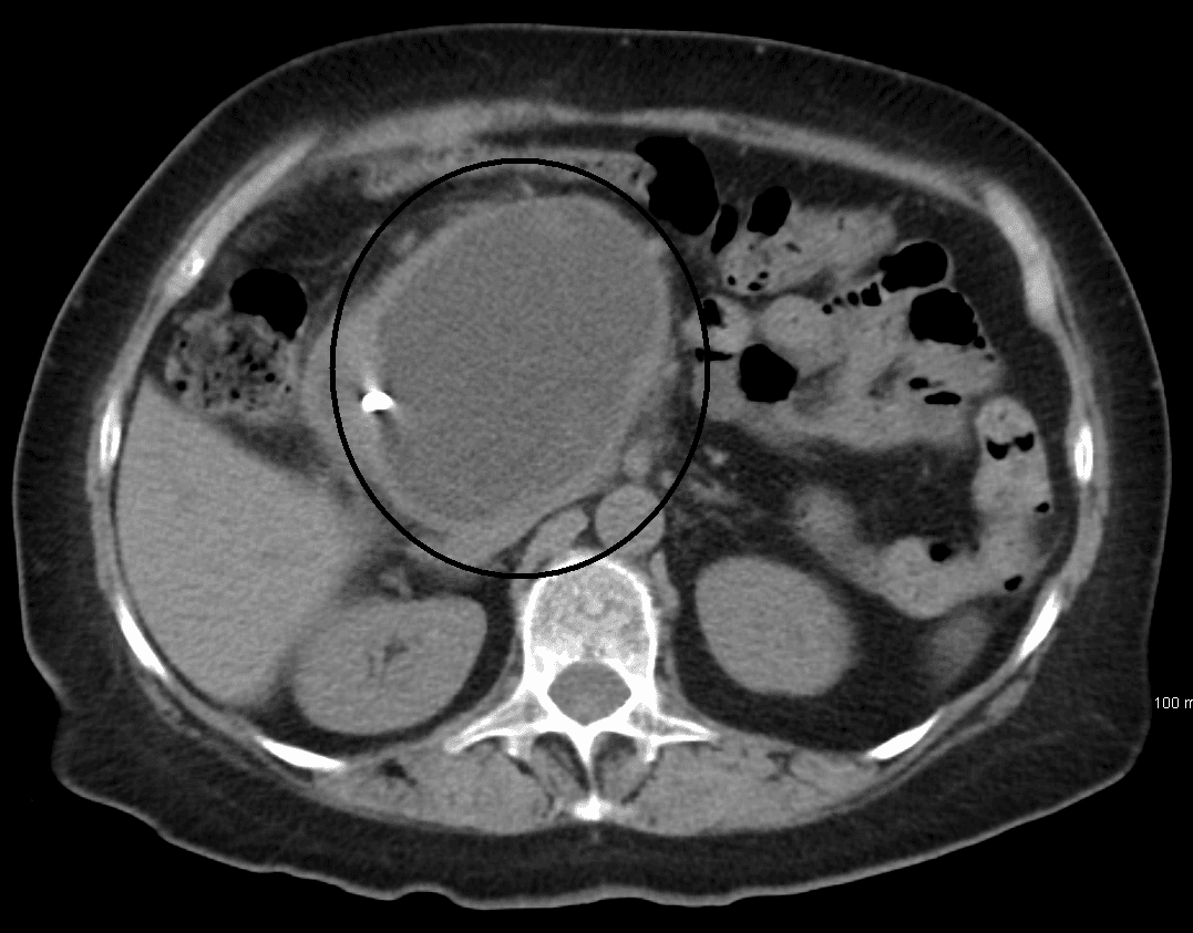 Pancreatic pseudocyst - Wikipedia