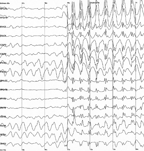 Electroencephalography - Wikipedia