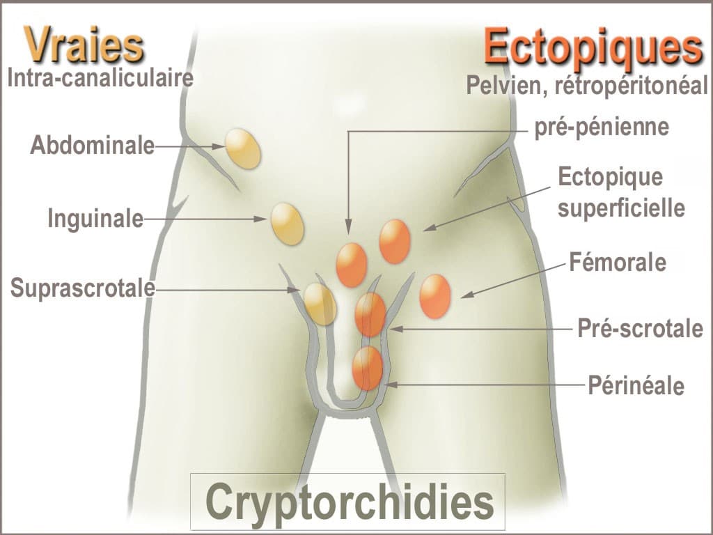 Cryptorchidism - Wikipedia