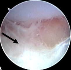 Septic arthritis - Wikipedia