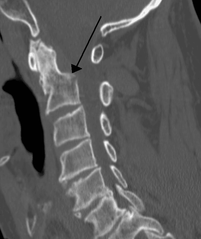 Traumatisme cervical — Wikipédia