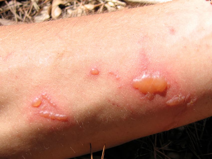 Phototoxicité — Wikipédia