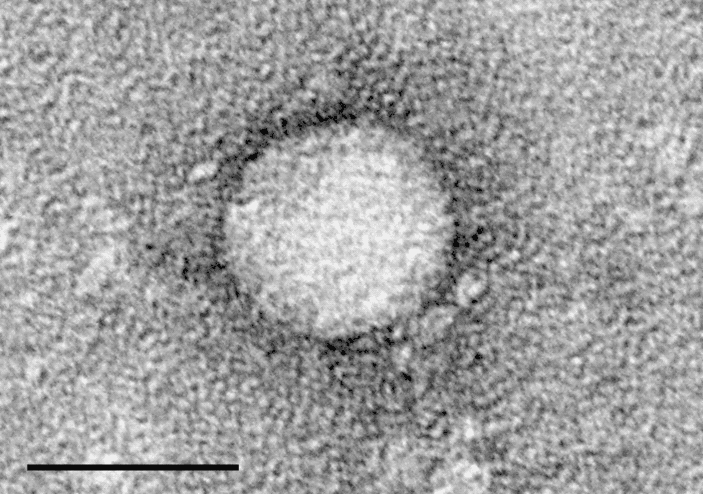 Hepatitis C - Wikipedia