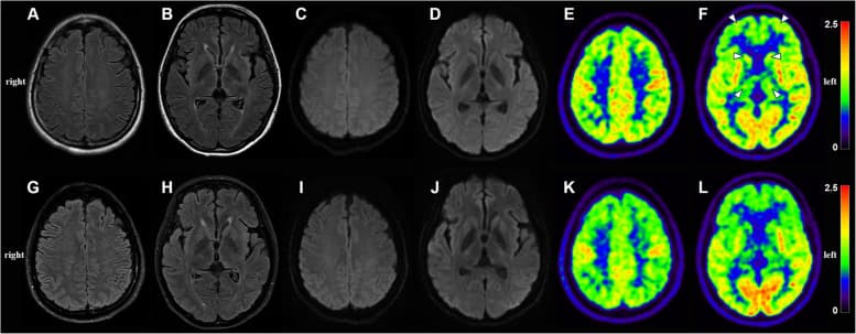 Fatal insomnia - Wikipedia