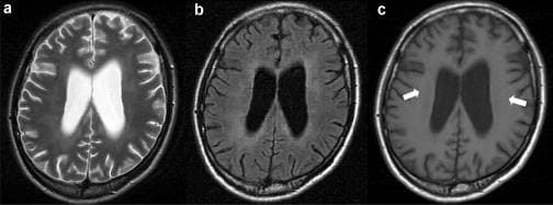 Encéphalopathie — Wikipédia