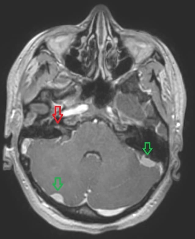 Neurofibromatose de type II — Wikipédia