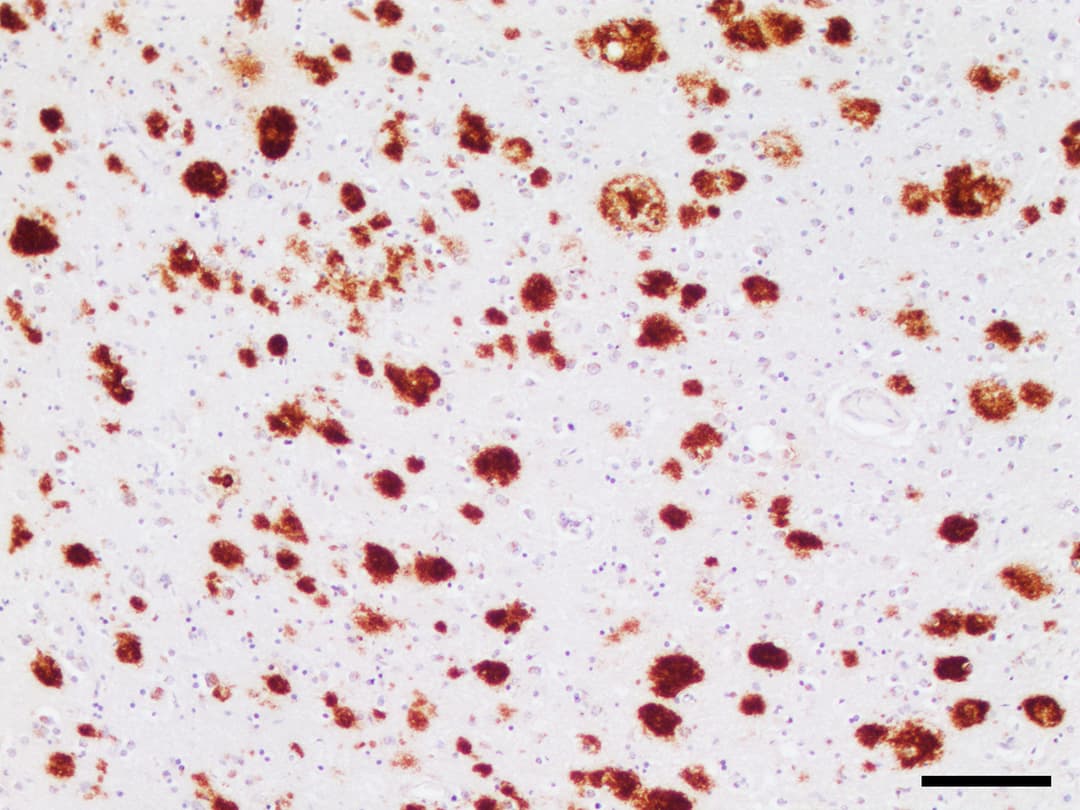 Proteinopathy - Wikipedia
