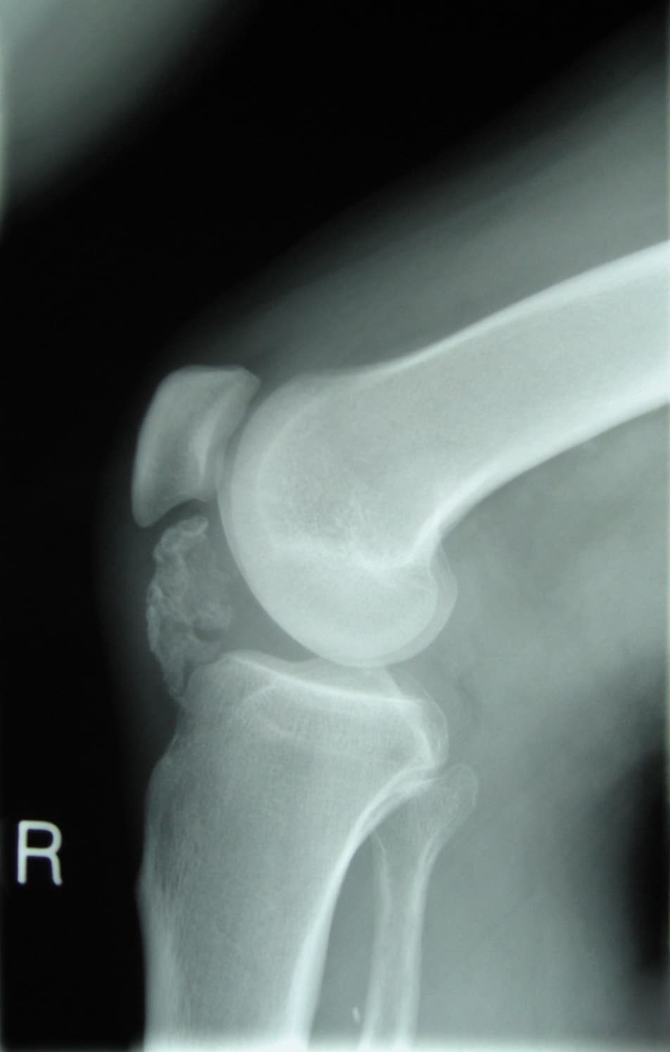 Osteochondroma - Wikipedia