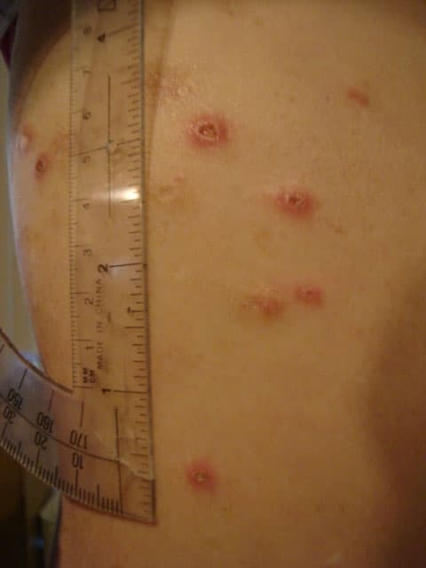 Ulcer (dermatology) - Wikipedia