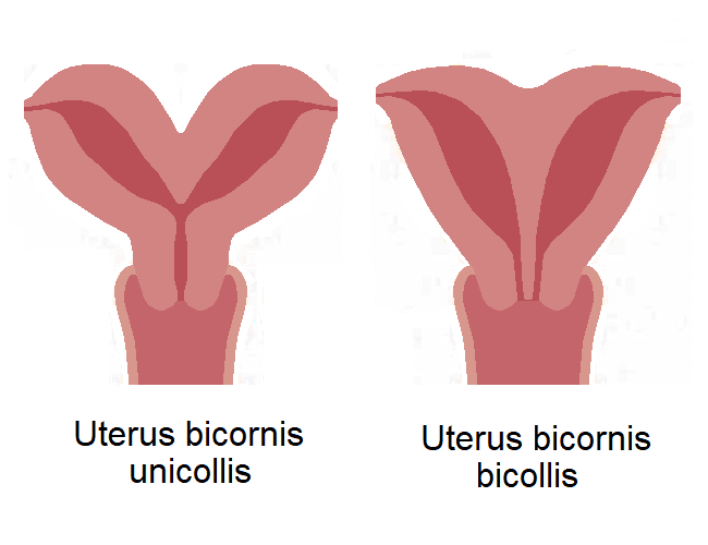 Bicornuate uterus - Wikipedia