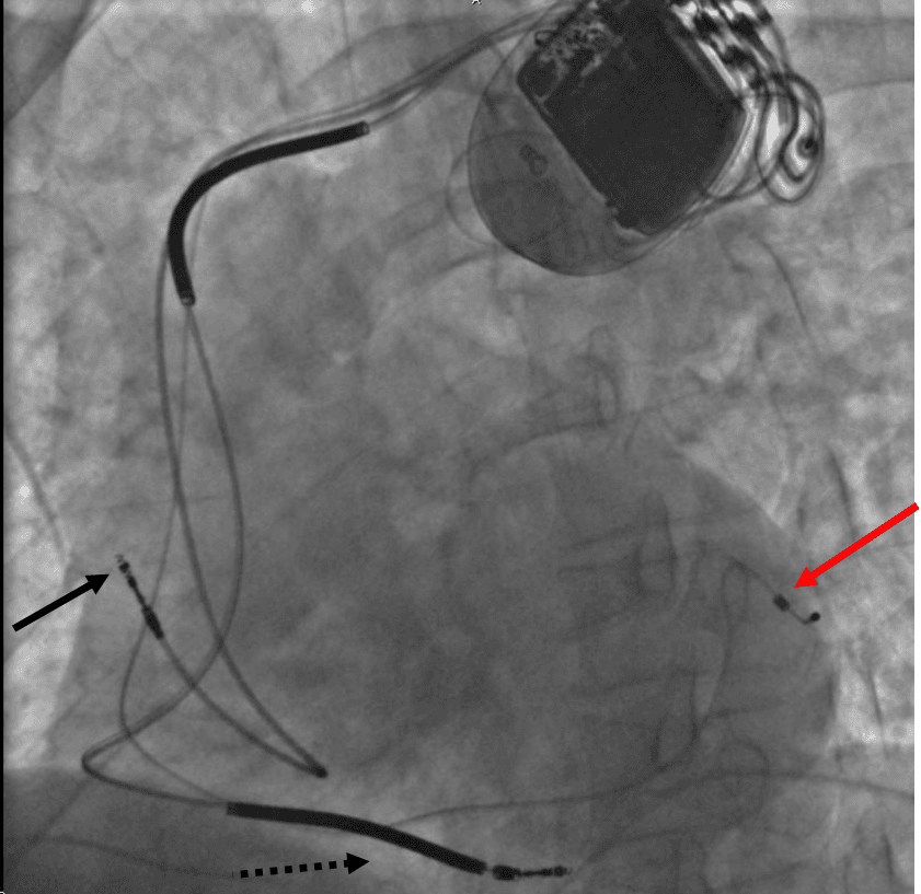 Cardiac resynchronization therapy - Wikipedia