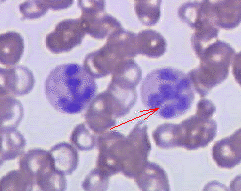 Megaloblastic anemia - Wikipedia