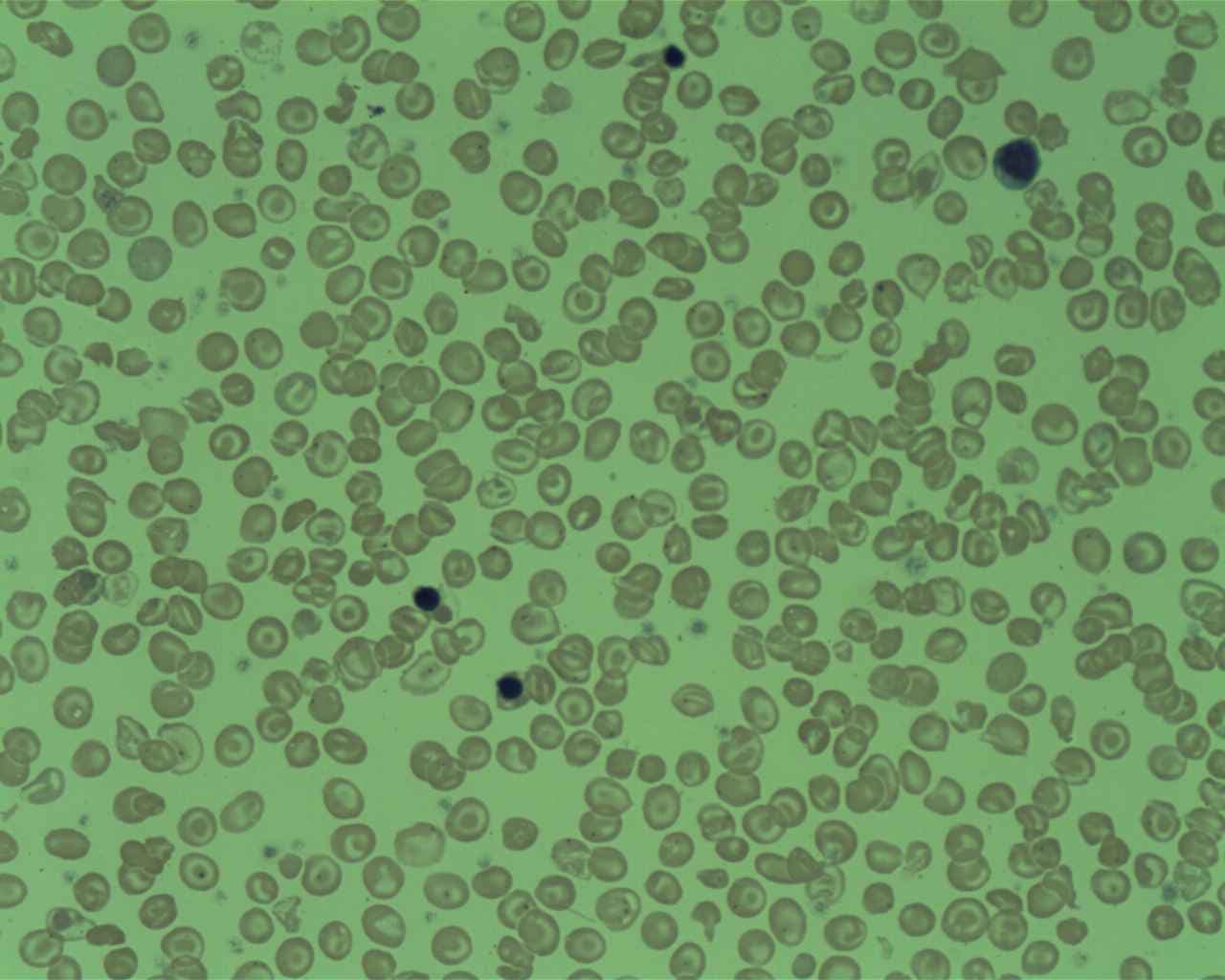 Thalassemia - Wikipedia