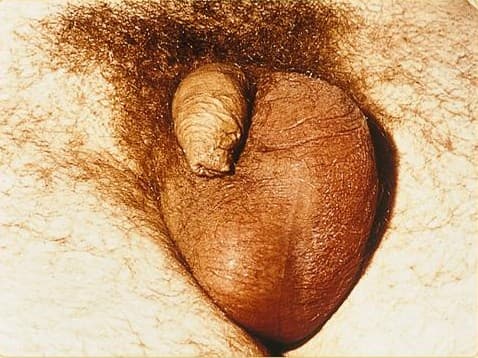 Épididymite — Wikipédia