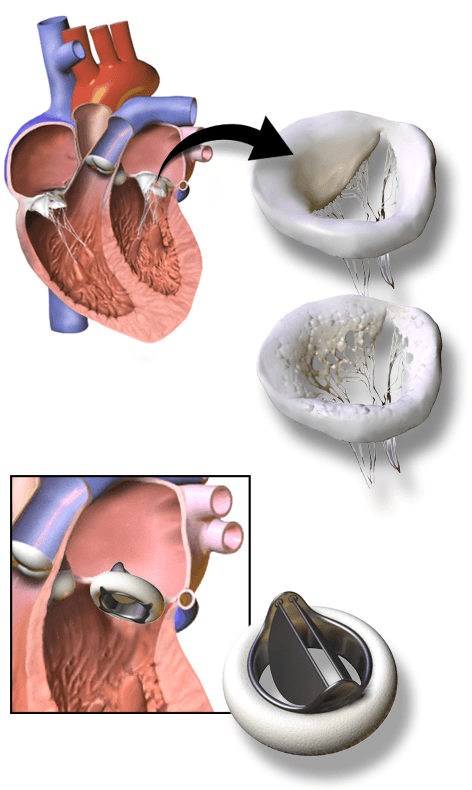 Remplacement valvulaire cardiaque — Wikipédia