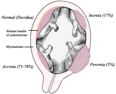 Placenta accreta spectrum - Wikipedia