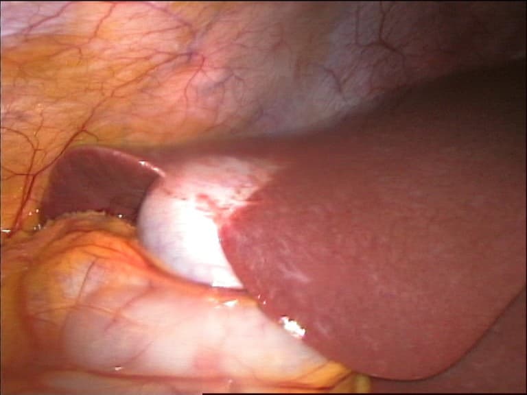 Cœlioscopie — Wikipédia