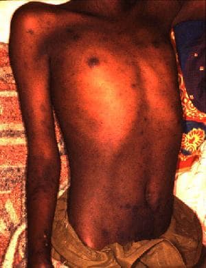 Typhus exanthématique — Wikipédia