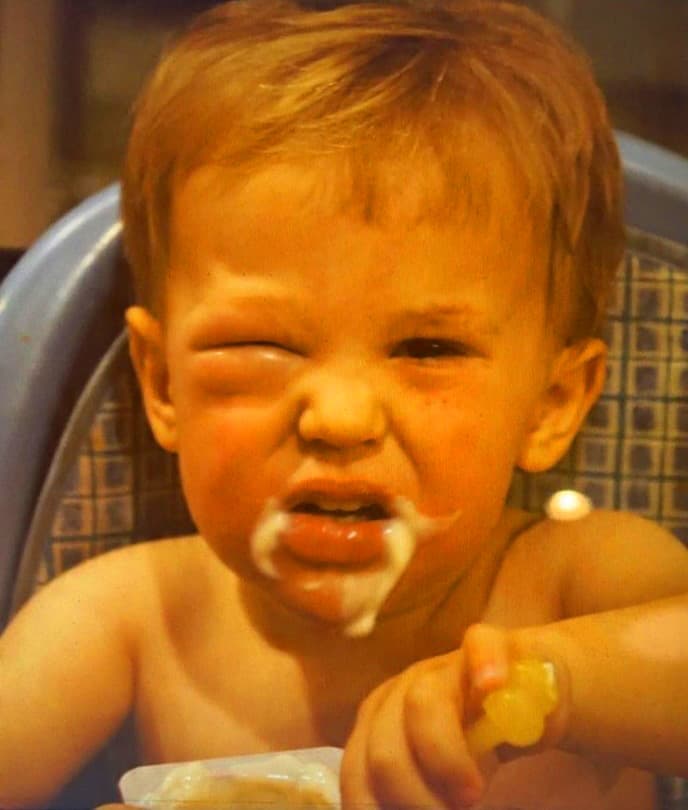 Food allergy - Wikipedia