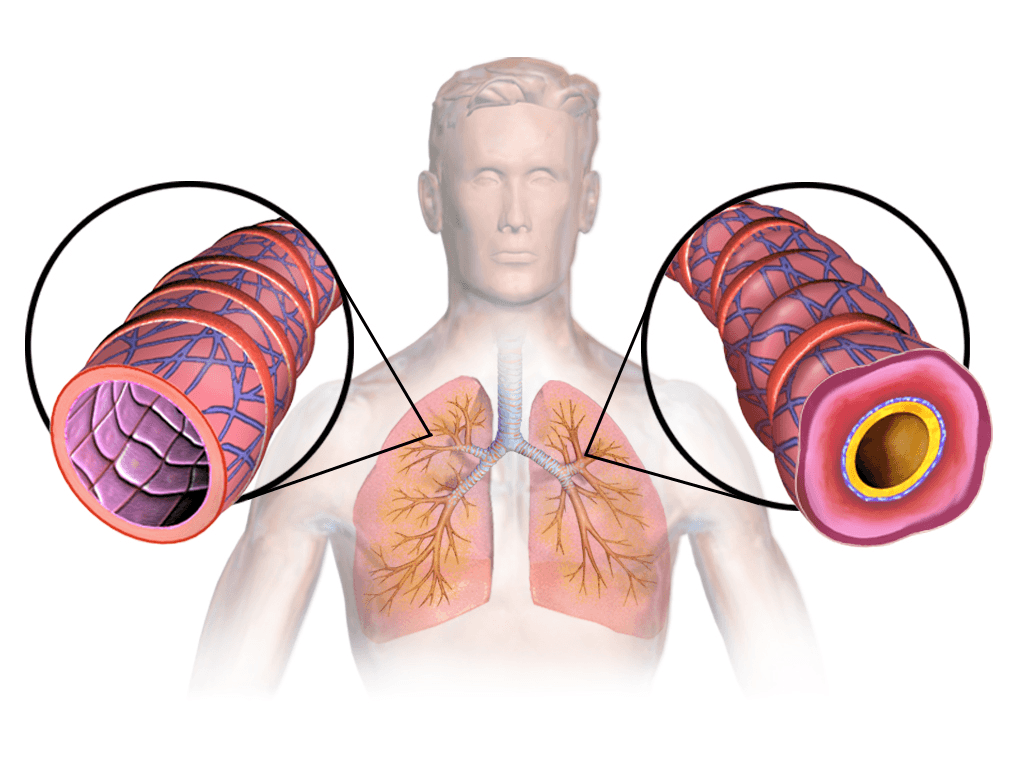Asthma - Wikipedia