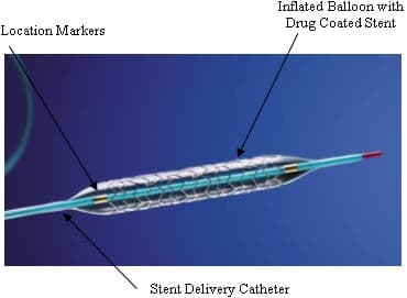 Implant - Wikipedia