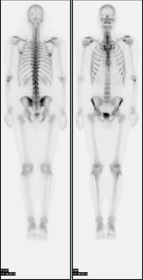 Bone scintigraphy - Wikipedia