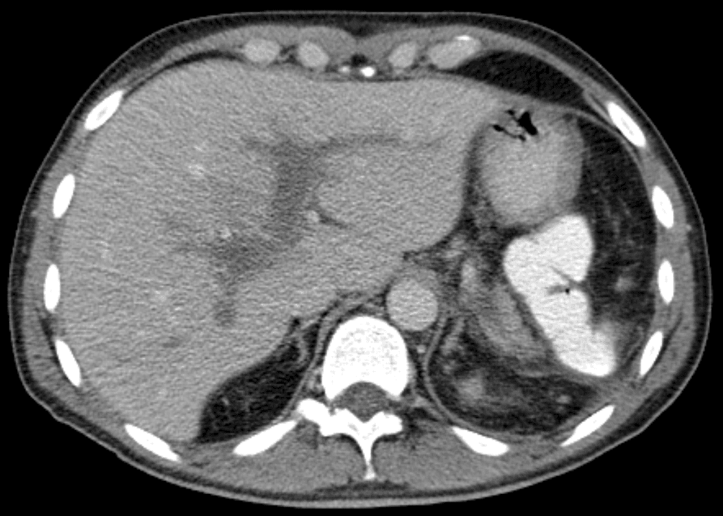 Portal vein thrombosis - Wikipedia