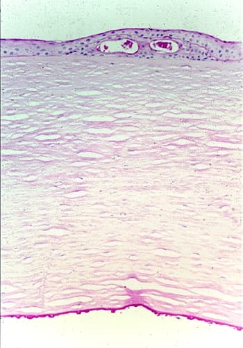 Fuchs' dystrophy - Wikipedia