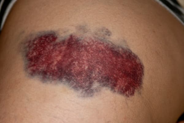 Bruise - Wikipedia
