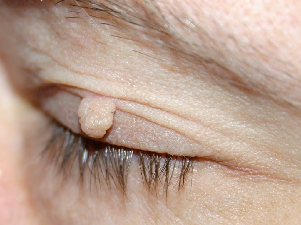 Néoplasie — Wikipédia