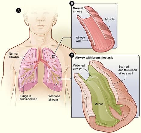 Bronchiectasis - Wikipedia