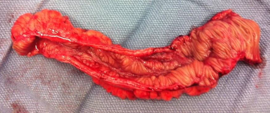 Intestine transplantation - Wikipedia