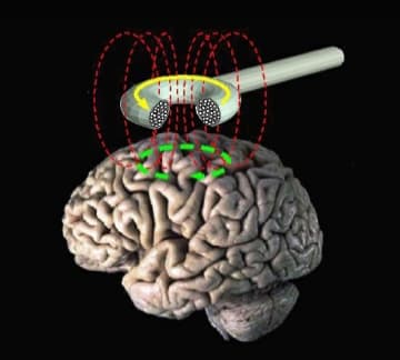 Transcranial magnetic stimulation - Wikipedia