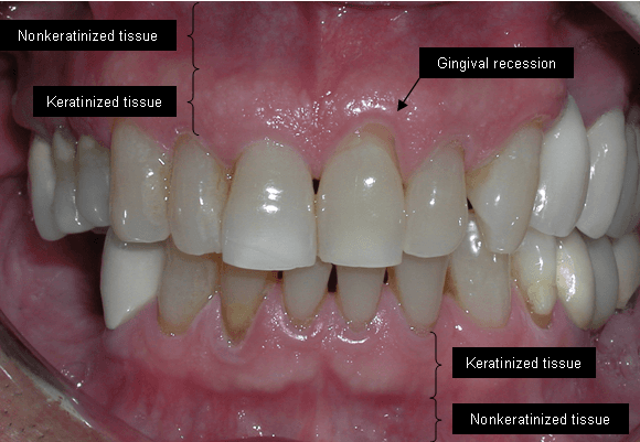 Gingival grafting - Wikipedia